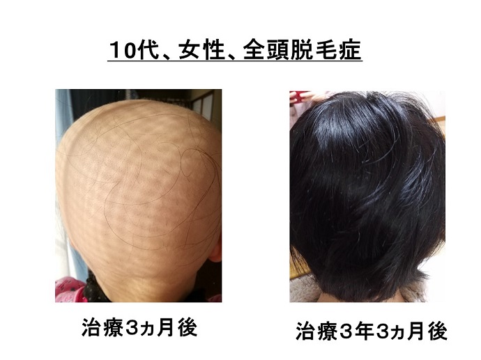 円形脱毛症　病院